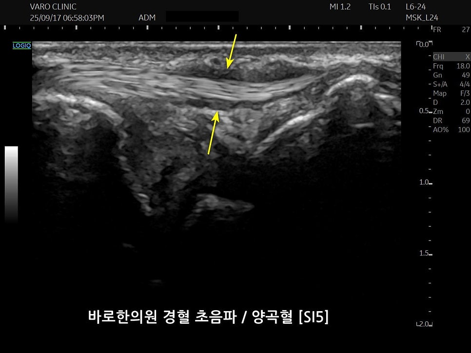 손목 척측 양곡혈(SI5) 부위의 초음파 영상으로, 노란색 화살표가 특정 구조를 가리키고 있다 — 초음파 정밀 진단 | 서울 바로한의원 초음파 약침·도침·침도