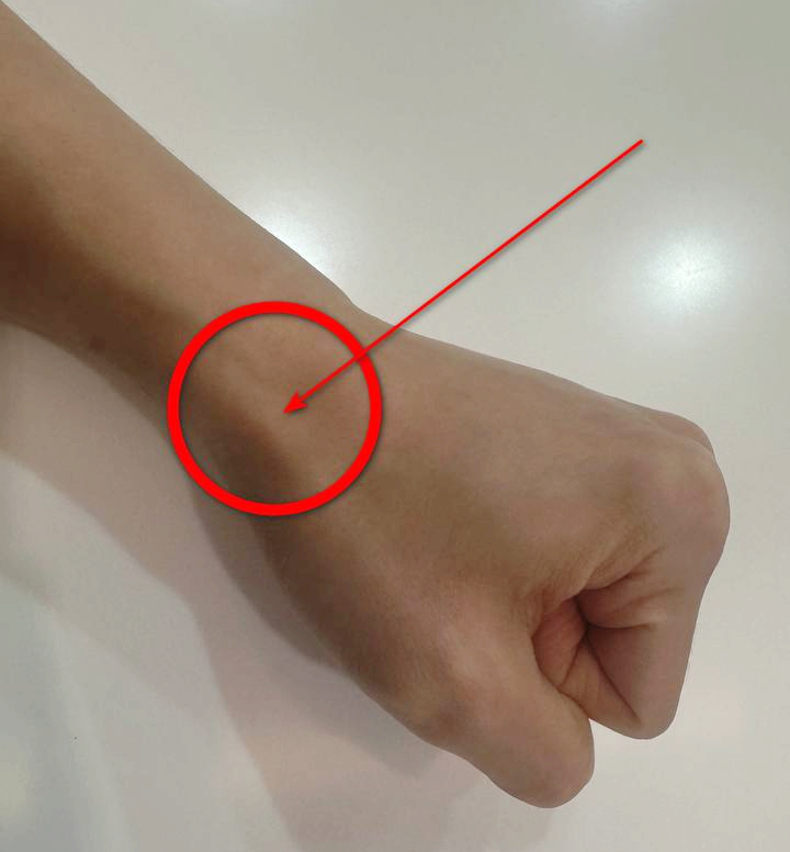 엄지손가락 쪽 손목 부위를 빨간 원과 화살표로 표시한 사진 — 서울 바로한의원 초음파 약침·도침