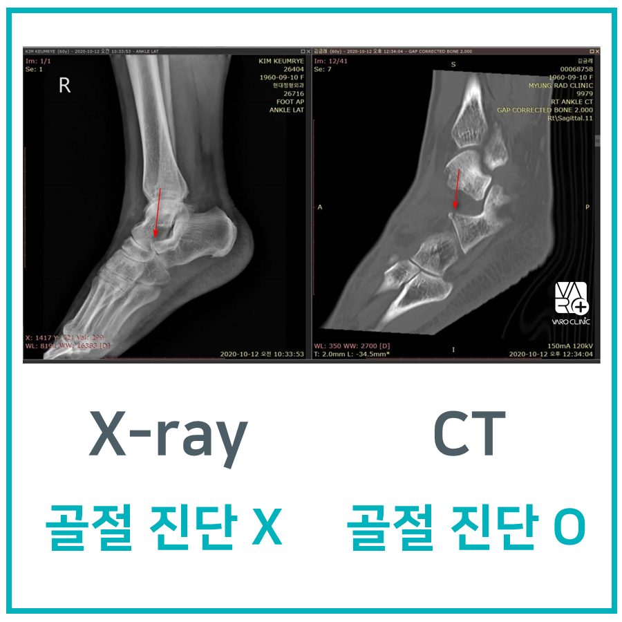 발목 X-ray와 CT 스캔을 나란히 보여주며, X-ray에서는 골절이 보이지 않고 CT에서는 골절이 화살표로 표시된 사진 — 서울 바로한의원 초음파 약침·도침