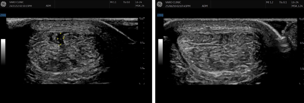 Achilles tendon tear — before/after ultrasound pharmacopuncture