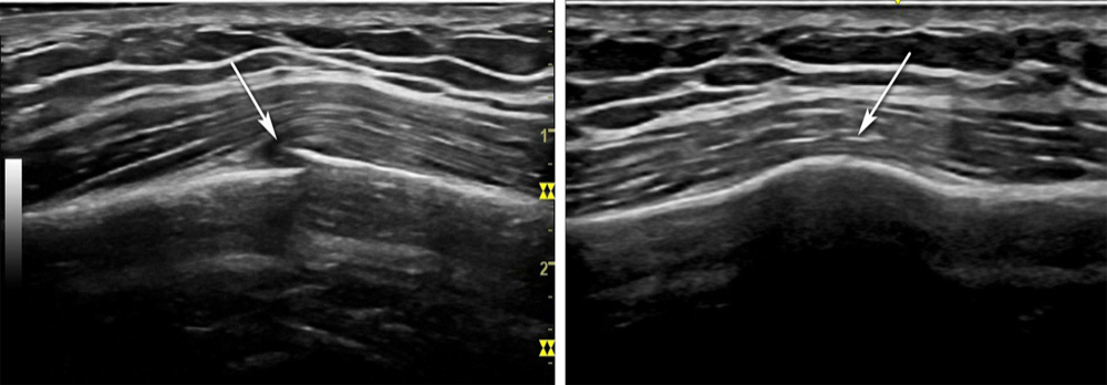 Rib fracture — before/after ultrasound-guided pharmacopuncture