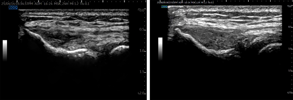Tennis elbow — before/after ultrasound acupotomy