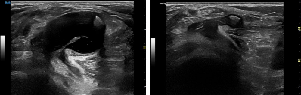 무릎 퇴행성 관절염 치료 전후